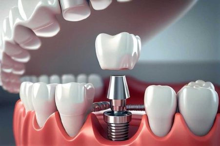 ایمپلنت های هوشمند چیست؟