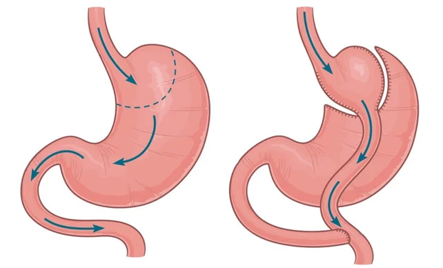 آیا عمل بای پس معده دردناک است؟ نکات مهم قبل و بعد از جراحی